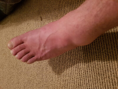 Swollen ankle